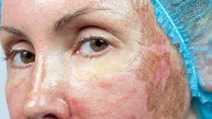 How To Treat Burns From Chemical Peel