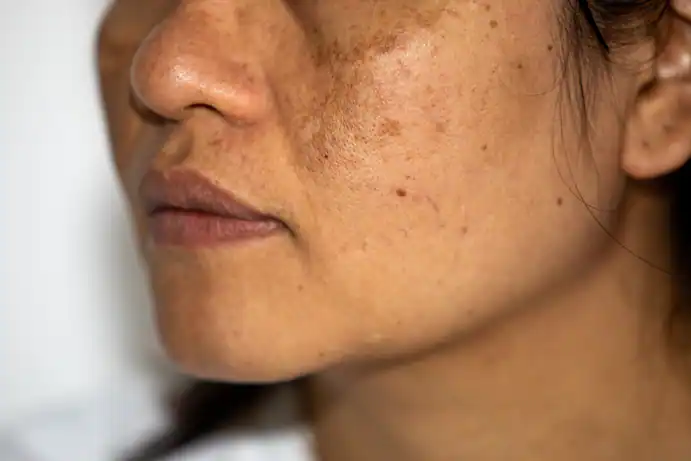 How To Treat Hyperpigmentation Cause By Chemical Peel