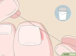 How To Treat Ingrown Toenail With Dental Floss