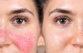 Is Laser For Rosacea Covered By Insurance