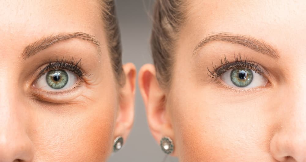 Is Botox For Crows Feet