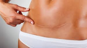 How Long Do I Wear Foam Boards After Tummy Tuck