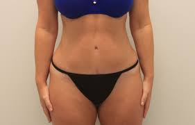 How Long Does a Tummy Tuck Surgery Take