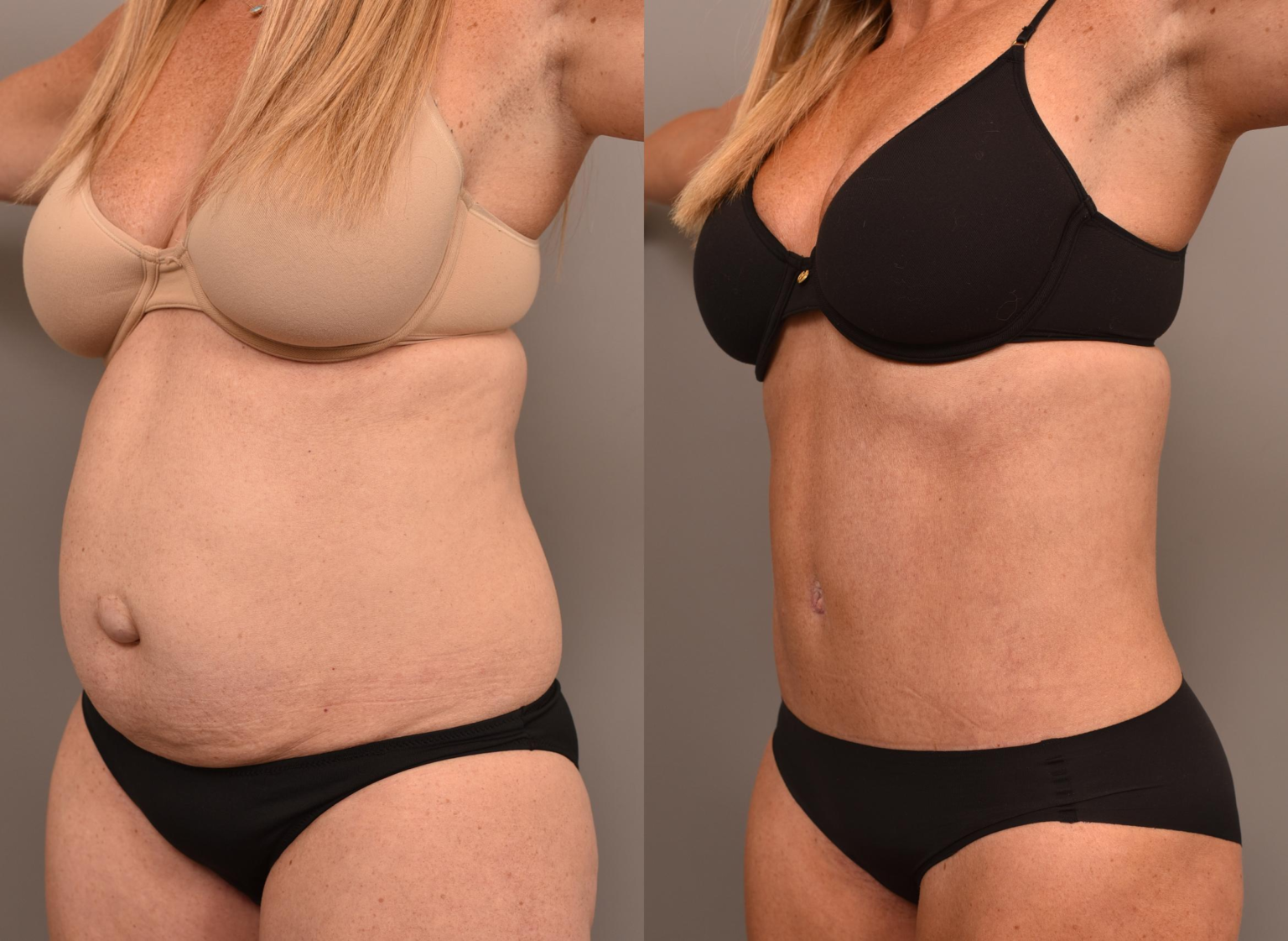 tummy-tuck-with-hernia-repair-cosmetic-surgery-tips