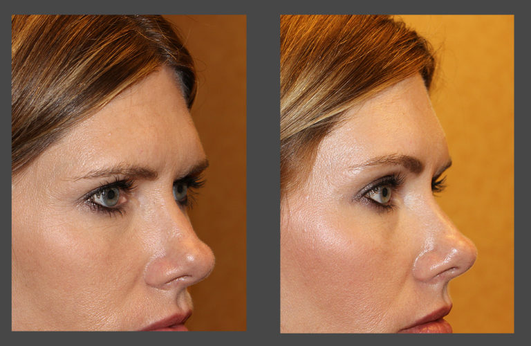 What Is The Average Cost Of A Brow Lift Cosmetic Surgery Tips