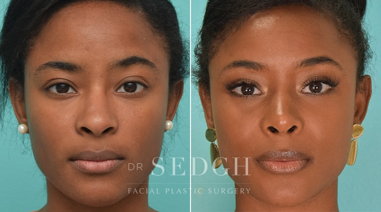 Black Women Rhinoplasty - Cosmetic Surgery Tips