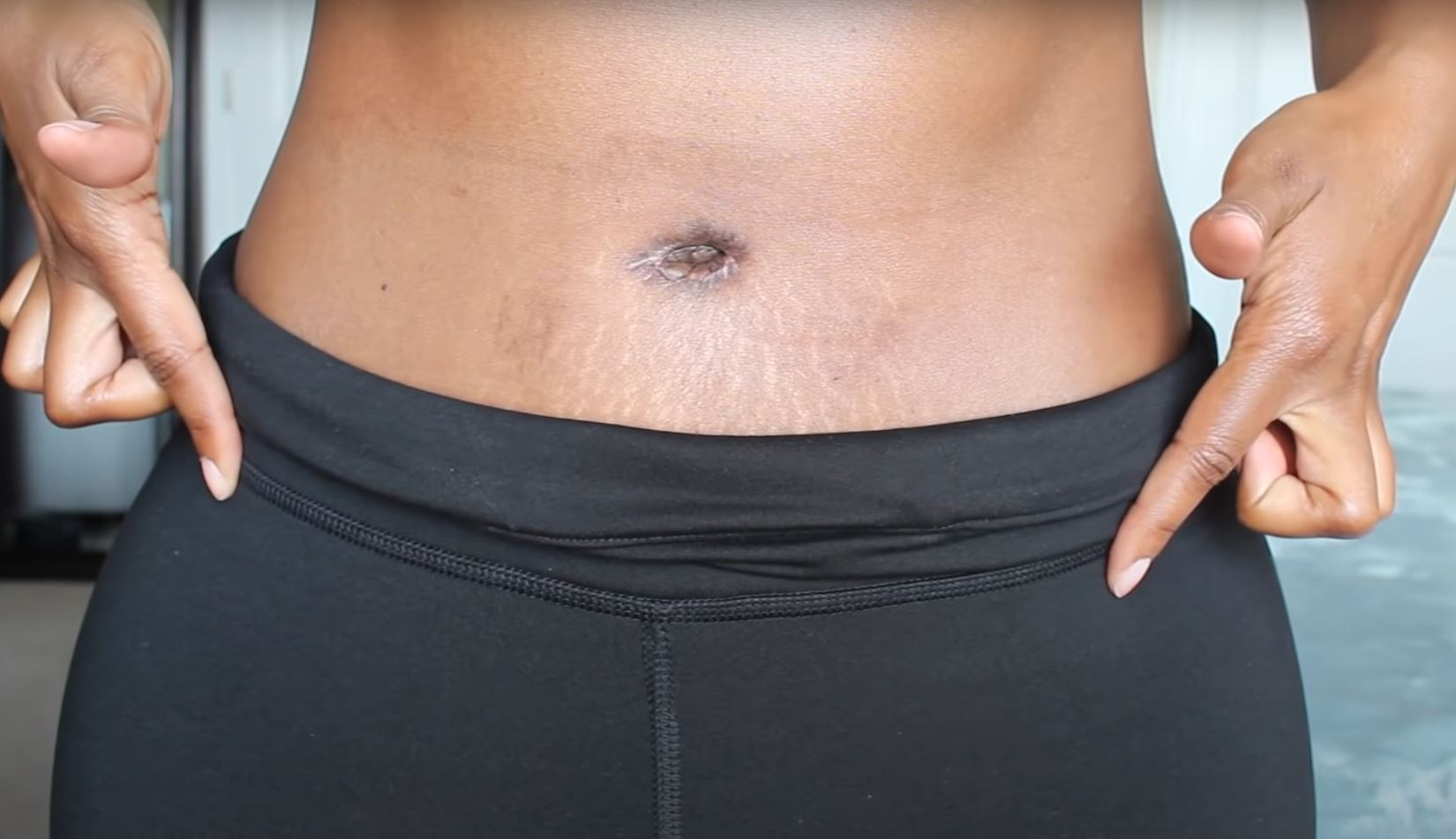 tummy-tuck-what-happens-to-the-belly-button-before-and-after-photos