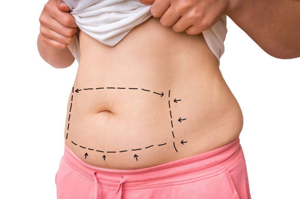 Tummy Tuck Covered By Insurance After C Sction